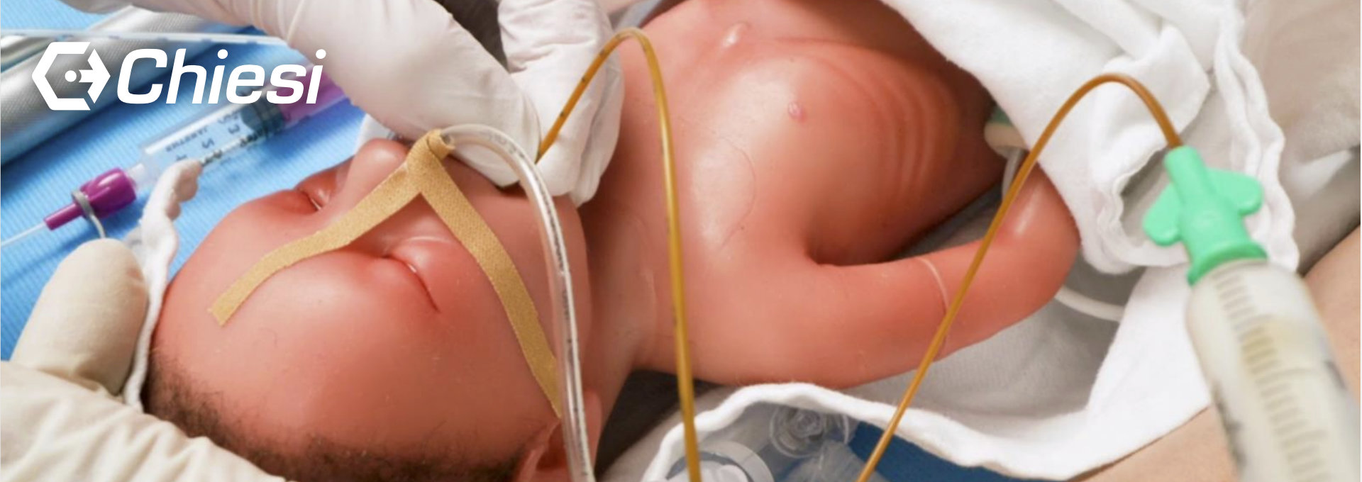 Ein neugeborenes Baby liegt auf einer medizinischen Unterlage. Es trägt eine Nasensonde, die mit einem Pflaster fixiert ist, und ein Beatmungsschlauch ist sichtbar. Eine Person mit weißen Einweghandschuhen hält eine Spritze, die an die Sonde angeschlossen ist, vermutlich zur Verabreichung von Nahrung oder Medikamenten. Das Baby hat dunkles Haar und ist teilweise in ein weißes Tuch eingewickelt. Die Szene findet in einer medizinischen Umgebung statt, möglicherweise auf einer Neugeborenen-Intensivstation (NICU). In der oberen linken Ecke ist das Logo "Chiesi" sichtbar.