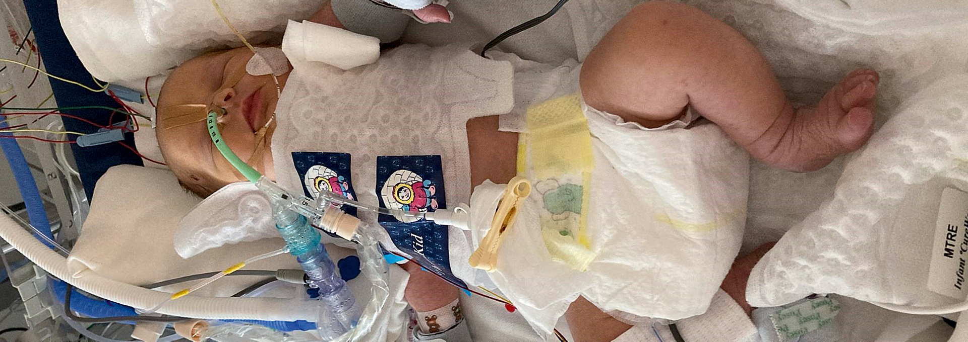 Ein Baby, das an medizinischen Geräten angeschlossen ist.