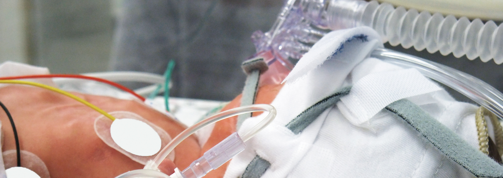 Frühgeborener Säugling mit Beatmungsmaske