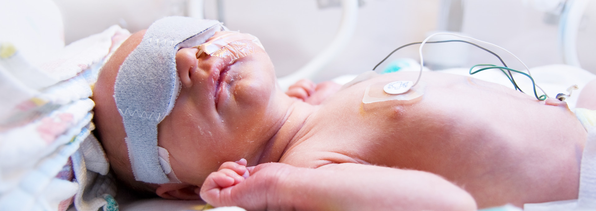 Frühgeborenes mit mehreren medizinischen Kabeln in klinischer Betreuung.