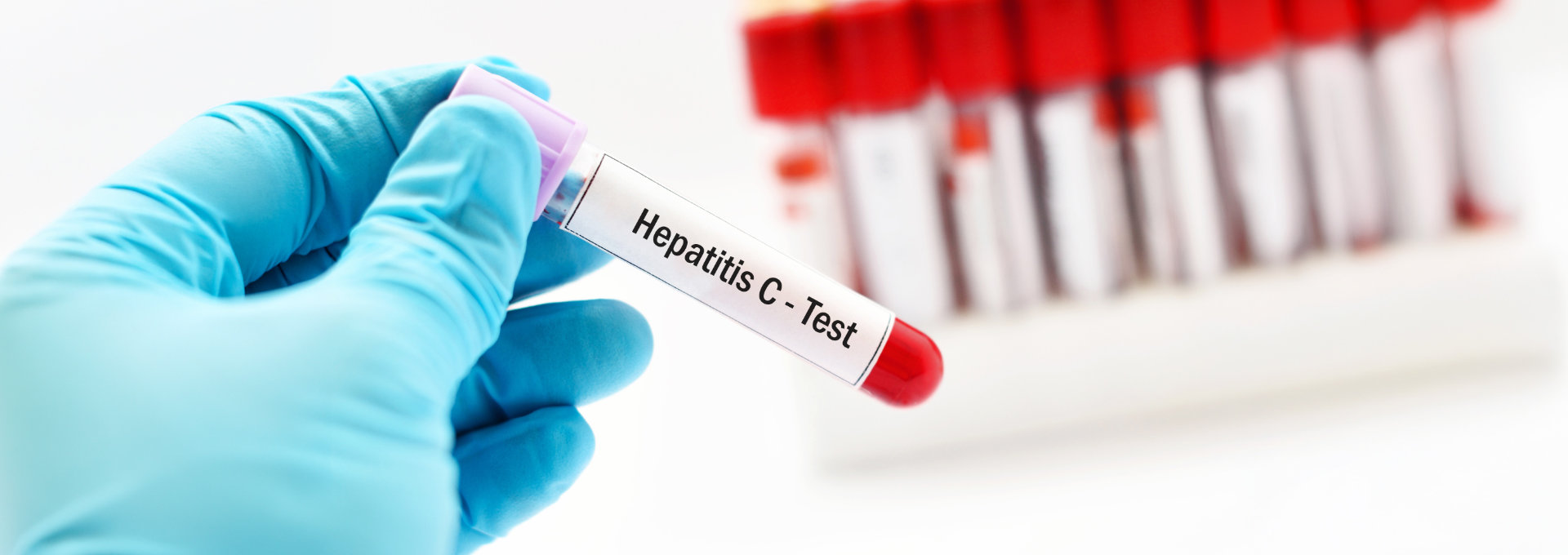 Eine Hand hält ein Reagenzglas mit einem Hepatitis C Test