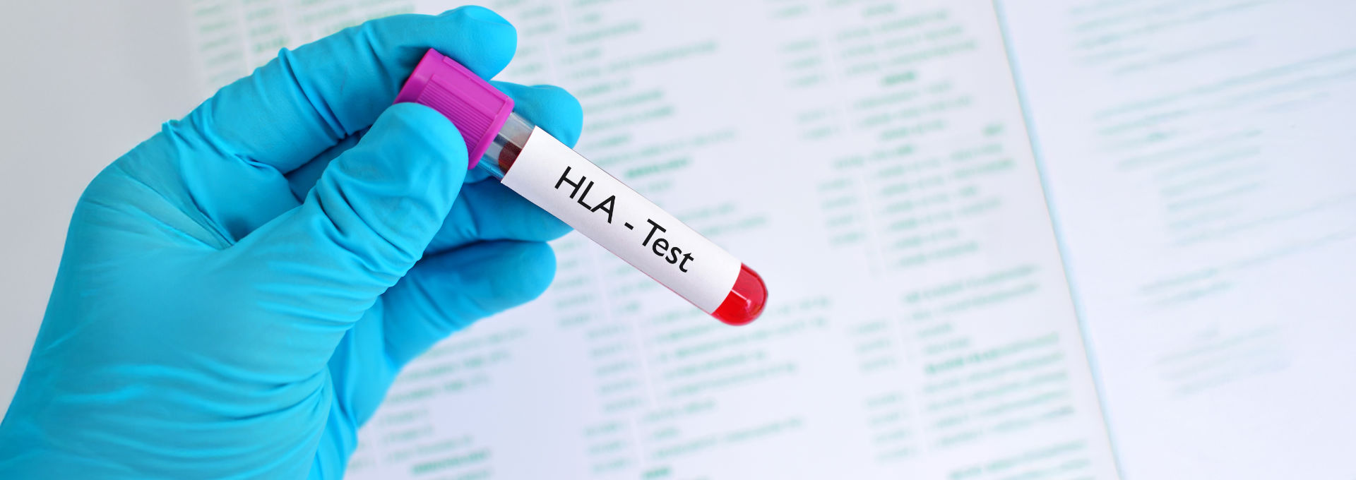Eine Hand in einem blauen Arzthandschuh hält eine Ampulle mit der Aufschrift "HLA-Test".
