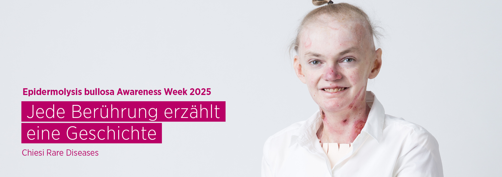 Eine Frau mit Symptomen der Seltenen Erkrankung Epidermolysis bullosa